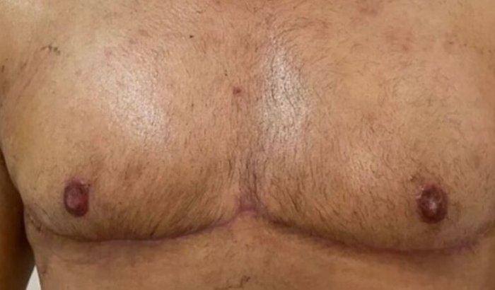 Realizando meu sonho de mastectomia