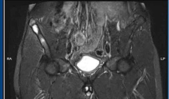 Cirurgia Osteoma Osteoide