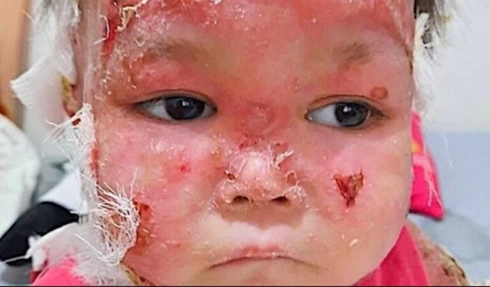 Ajude Maria Eduarda no tratamento contra a Epidermólise Bolhosa