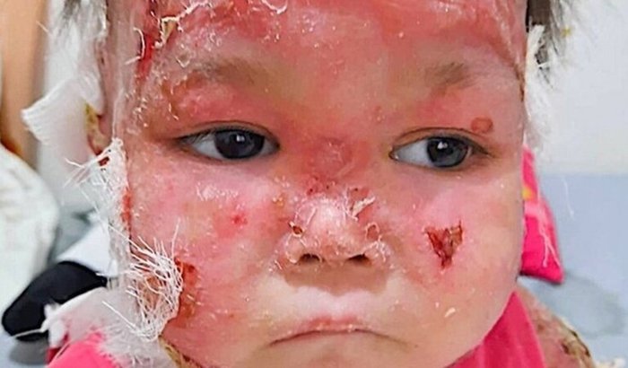 Ajude Maria Eduarda no tratamento contra a Epidermólise Bolhosa e dê alívio as suas dores!