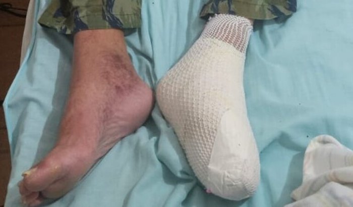 tratamento médico e ajuda financeira - diabetes necrosante - incapacidade para o trabalho