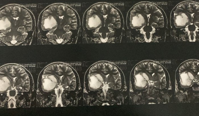 Tratamento e Cirurgia - Tumor Cerebral