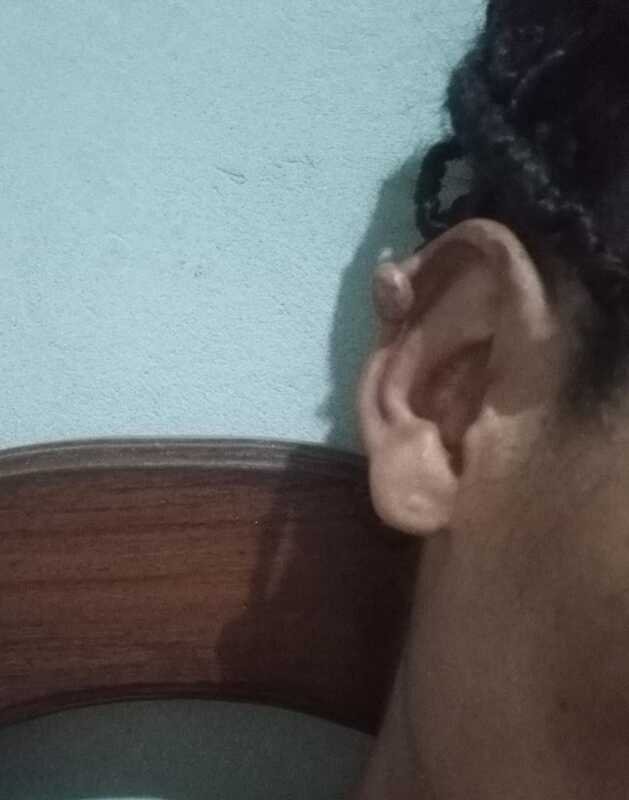 Sem condições, preciso da sua ajuda para cirurgia de queloides