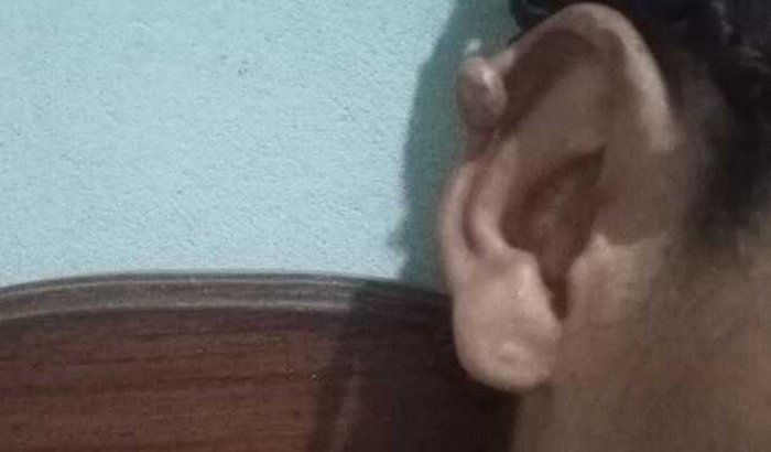 Sem condições, preciso da sua ajuda para cirurgia de queloides