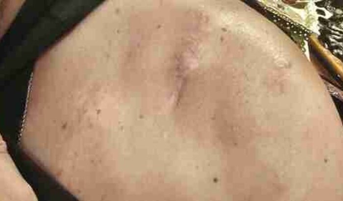 Cobrir cicatriz com tatuagem 