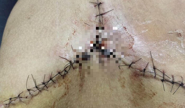 Ajuda para aquisição de Prótese Ortopédica e tratamento de reabilitação (fisioterapia)