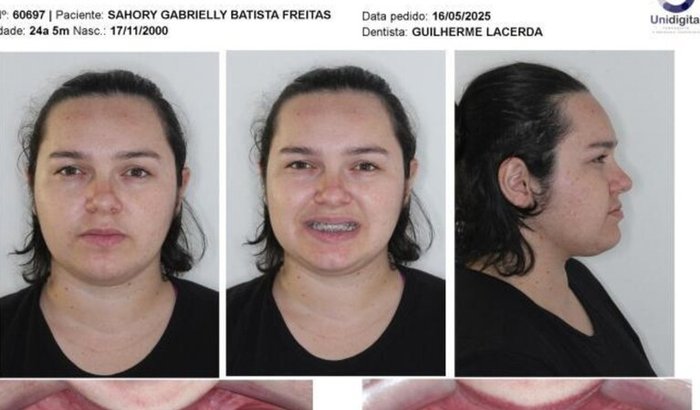 CIRURGIA ORTOGNATICA DA SAHORY 