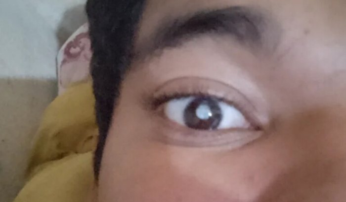 Cirurgia no olho direito e implante de lente artificial 