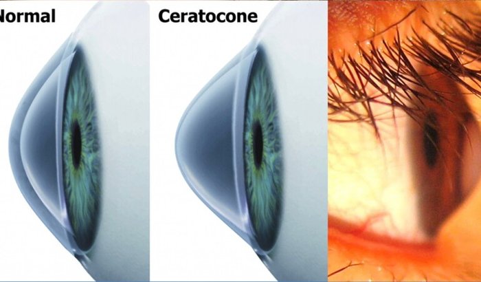 Cirurgia Ceratocone - Urgente - Alice Giovanna