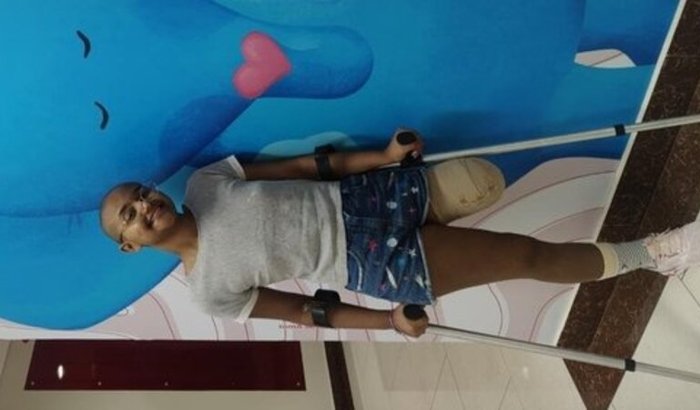 Prótese da Anna Cristina