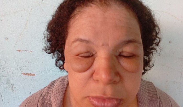 Fazer cirurgia de Blefaroplastia.