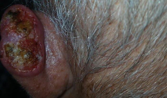 Cirugia Câncer Pele orelha