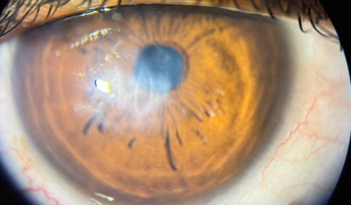 Cirurgia Solidária para Ceratocone Avançado