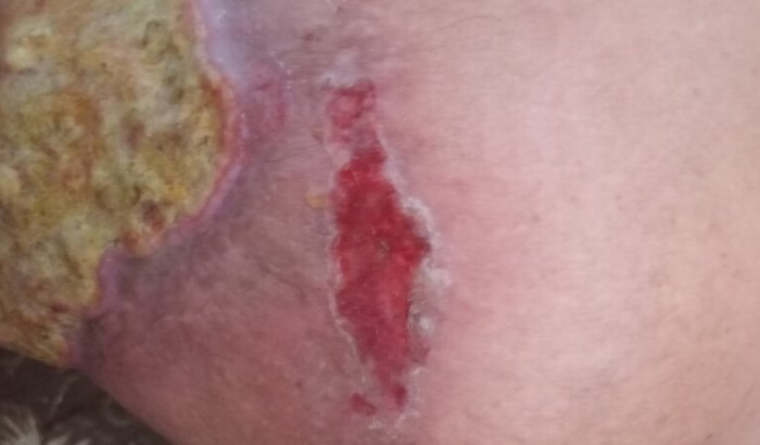 Ajuda pra tratamento de Eresipela muito avançada na perna