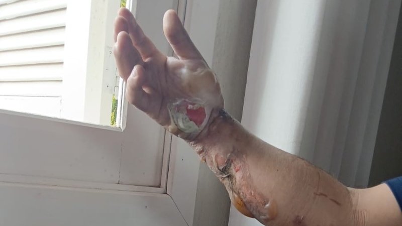imagem da vaquinha Ajuda para o tratamento de queimaduras do Vanderlei 