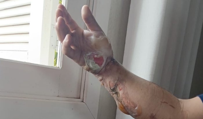 Ajuda para o tratamento de queimaduras do Vanderlei 