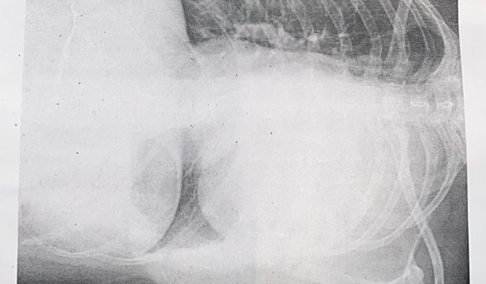 Ajude a yasmim a tratar o pulmão