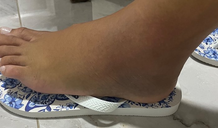 Tratamento após lesão de tornozelo