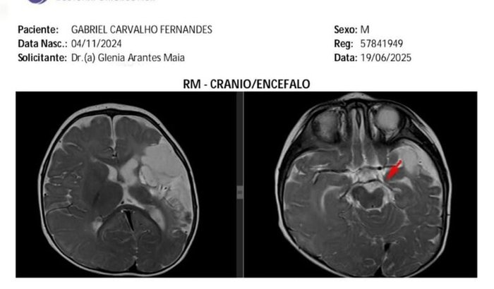Tratamento do Gabriel 