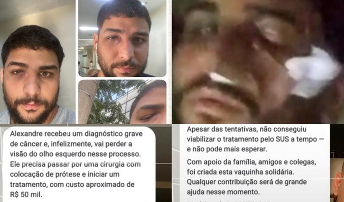 Cirurgia emergente câncer maligno no olho