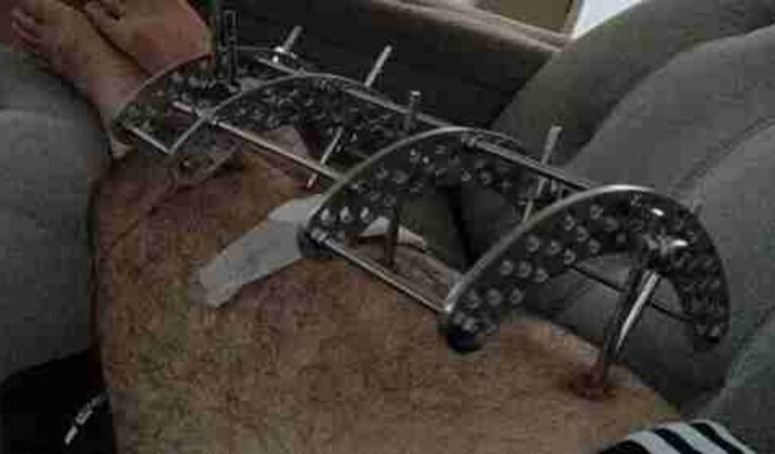 Ajuda para o tratamento de osteomielite