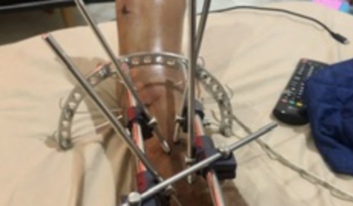 Ajude o Leandro a se recuperar e recomeçar após tentativa de assalto