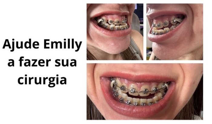 Doe Qualidade de Vida – Apoie a Cirurgia Ortognática da Emilly