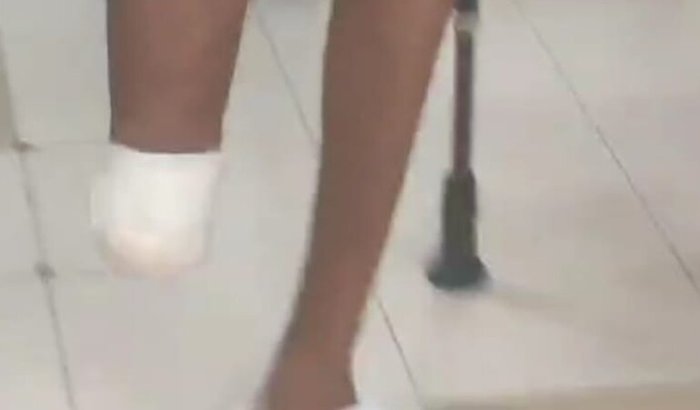 Uma prótese para o Charles 
