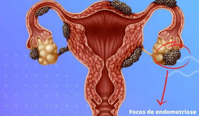 CIRURGIA DE ENDOMETRIOSE PROFUNDA INFILTRATIVA
