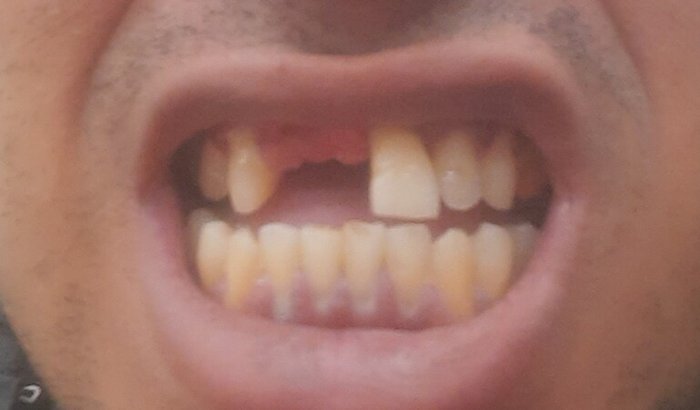 Para me ajudar a colocar 3 dentes.