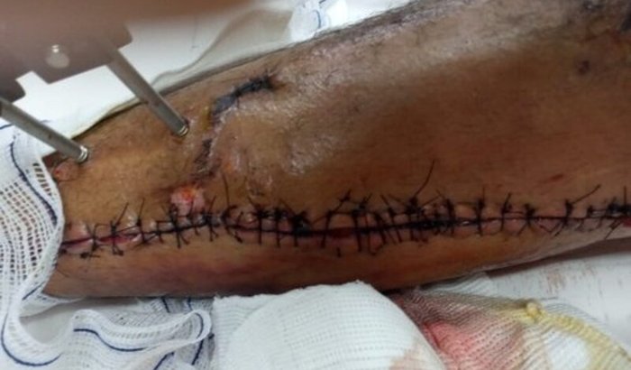 Tive um acidente de moto e preciso da sua ajuda 🙏