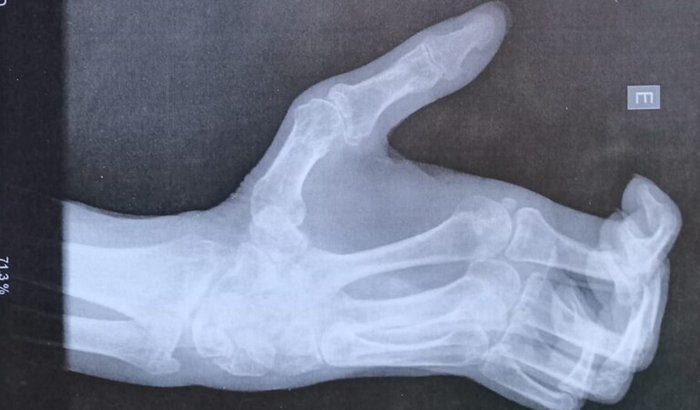 Cirurgia Paulo Roberto Henkes