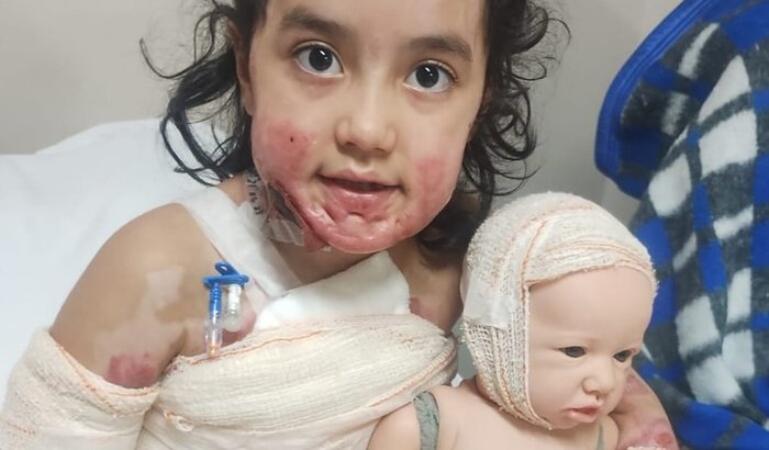 Tratamento para Queimadura.