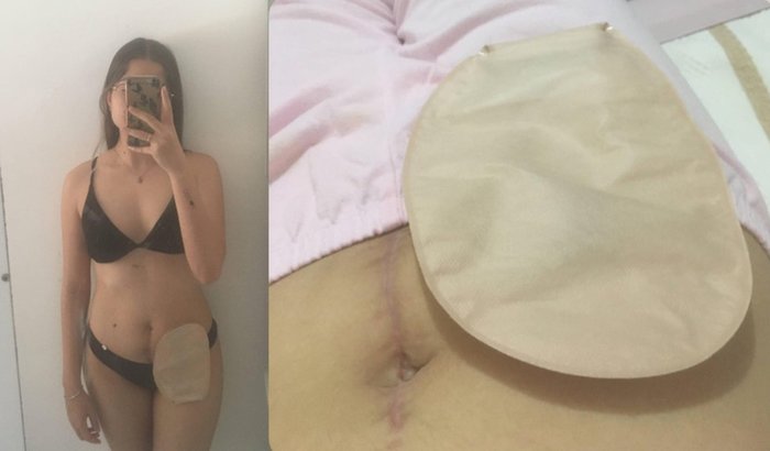 Cirurgia Pela Fístula: Apoie a Rafa