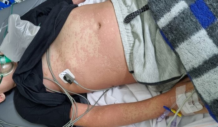 Imunoterapia após choque anafilático
