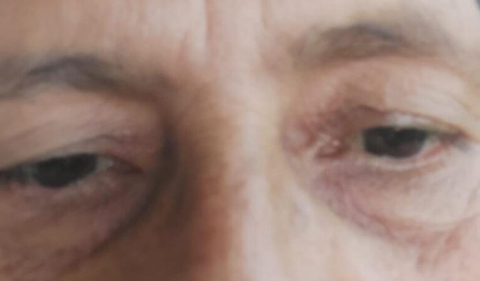 Tratamento 💊Oftalmológico.