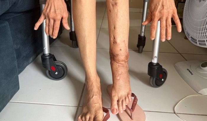 Cadeira de rodas elétrica para mãe com artrite reumatoide