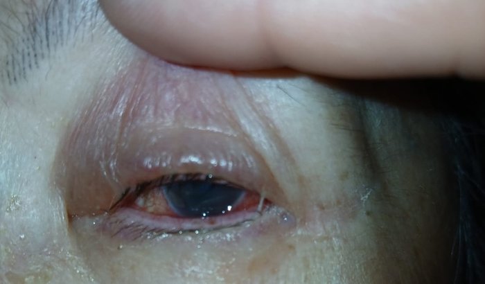 Cirurgia de vitrectomia ( Todos por Júlia)