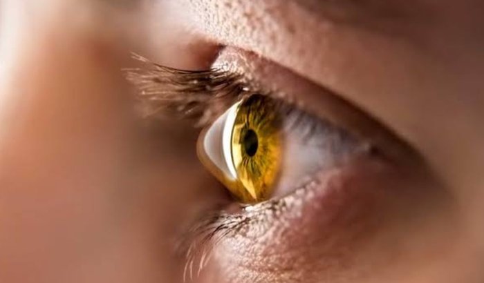 Transplante de córnea (Ceratocone)