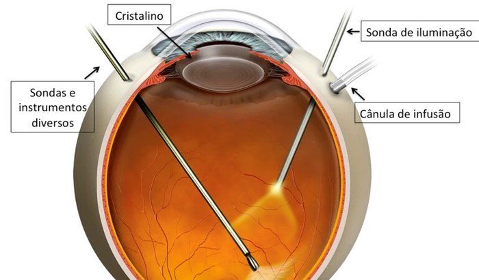 Cirurgia de Descolamento de Retina (Vitrectomia)