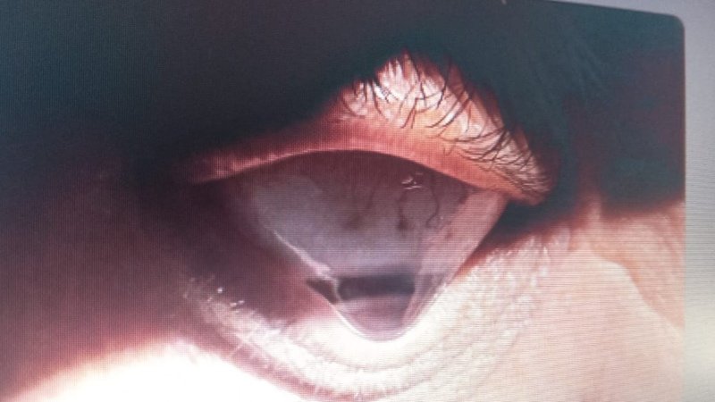 imagem da vaquinha Cirurgia de córnea dos dois olhos 