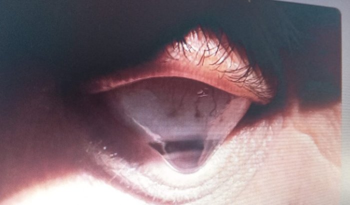 Cirurgia de córnea dos dois olhos 