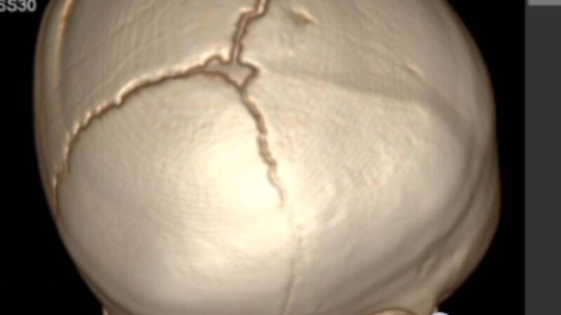 imagem da vaquinha Ajude a Aurora a fazer a cirurgia de cranioestenose