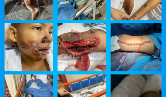 Prótese para o Gustavo 🦿