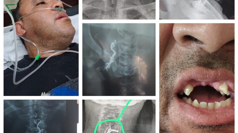 imagem da vaquinha Ajuda para um Implante de 4 dentes