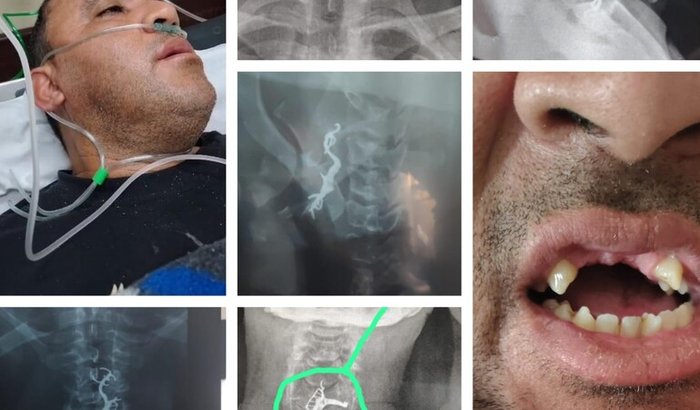 Ajuda para um Implante de 4 dentes