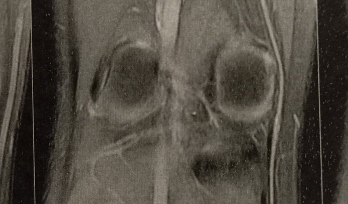 Ajudar para uma cirugia no ligamento cruzado