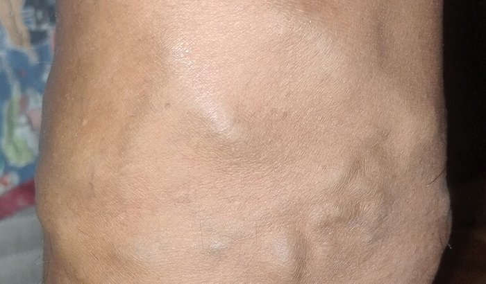 Preciso para fazer a operação da minhas varizes riscos de trombose