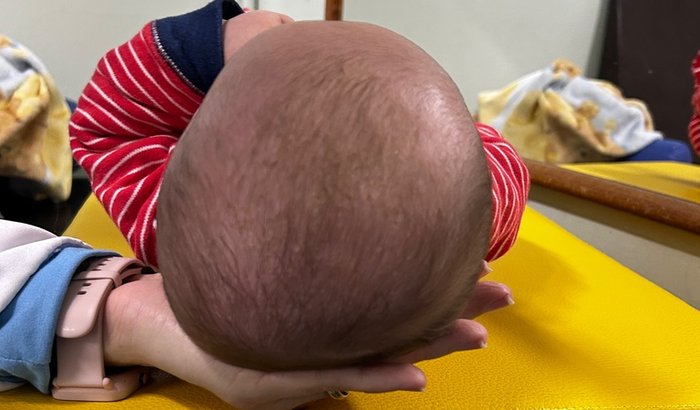 Tratamento Arthur - Órtese Craniana