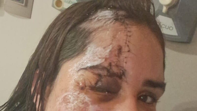 imagem da vaquinha Ajude a cirurgia de reconstrução da Elisa